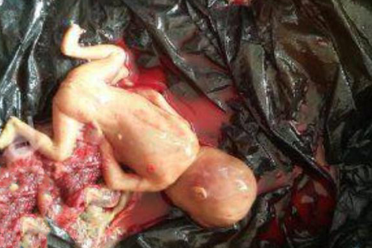 孕11周引产四肢形成图