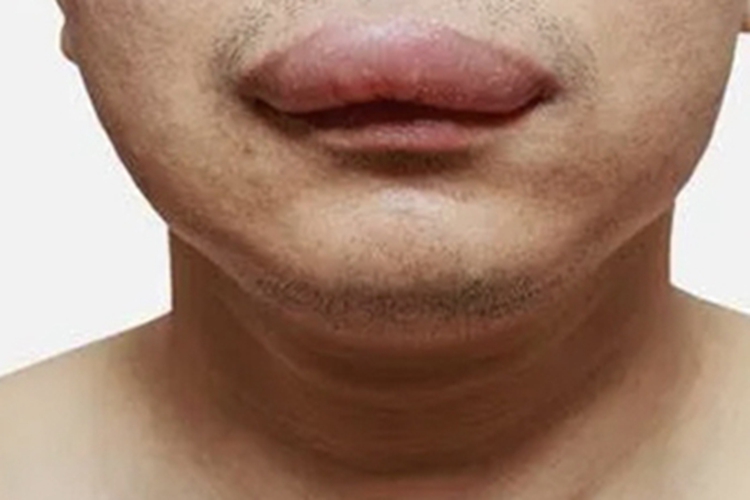 遗传性血管性水肿症状图