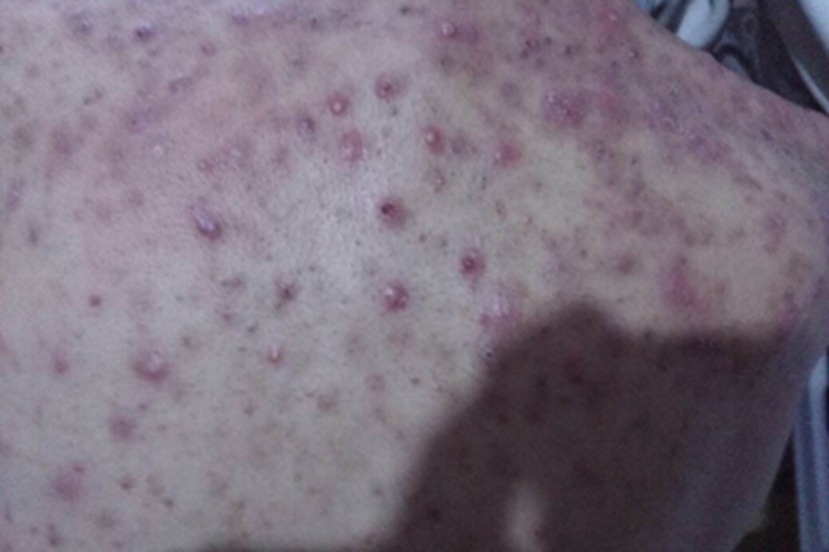 暴发性痤疮背上都是丘疹图