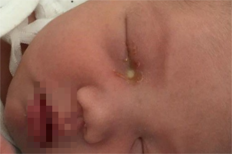 新生儿眼屎增多图