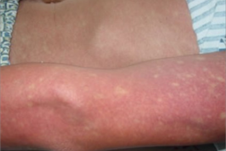 登革热胳膊长红斑图