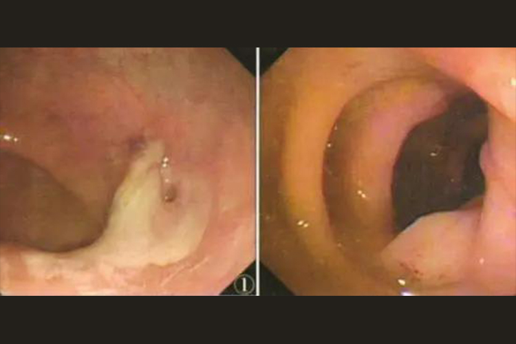 增生型肠结核肠镜检查图