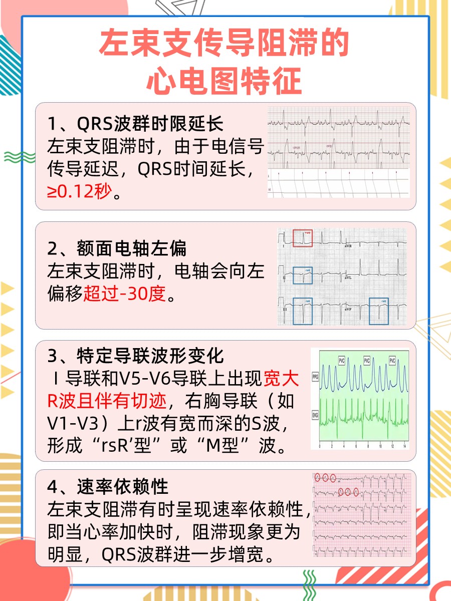 左束支传导阻滞的心电图特征，一文教你识别！