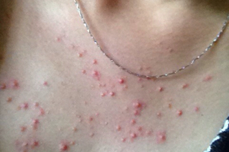 嗜酸性脓疱性毛囊炎胸部长丘疹图