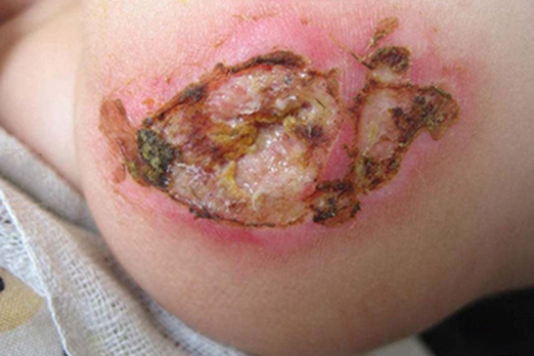 脓窝疮屁股破溃糜烂图