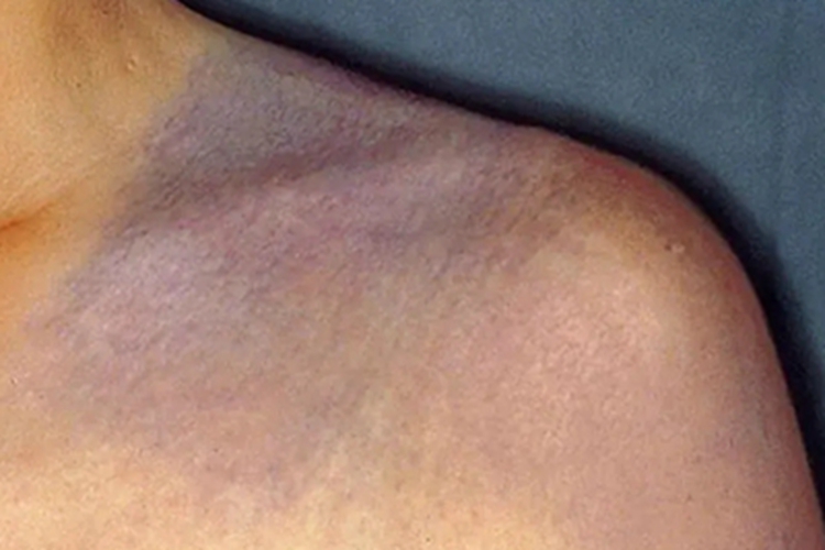 伊藤痣肩部斑图