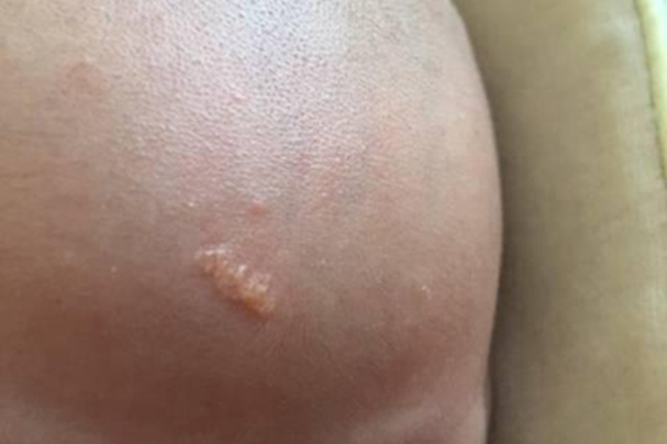 皮脂腺痣前额疙瘩图