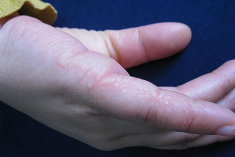 条纹状掌跖角化病症状图