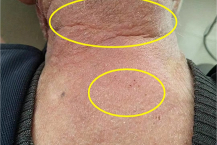 播散性神经性皮炎颈部丘疹图 播散性神经性皮炎颈部丘疹图