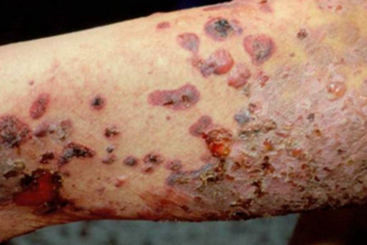 大疱性表皮松解症胳膊症状图