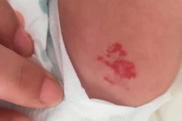 新生儿鲜红斑痣图 新生儿鲜红斑痣图