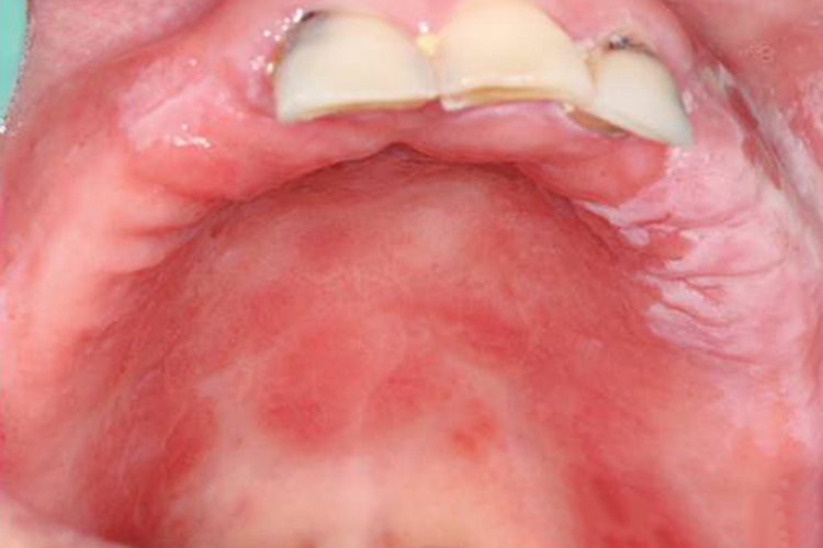 义齿性口炎图 义齿性口炎图