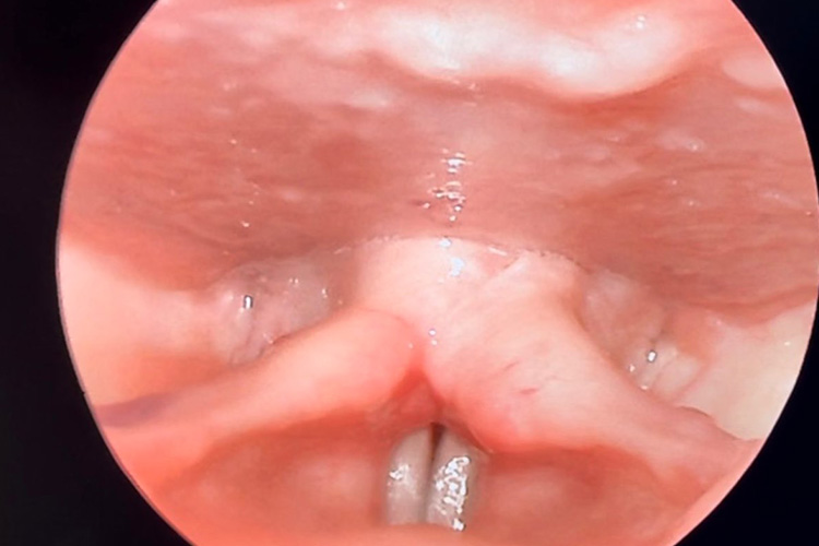咽后壁处颗粒状隆起的淋巴滤泡图