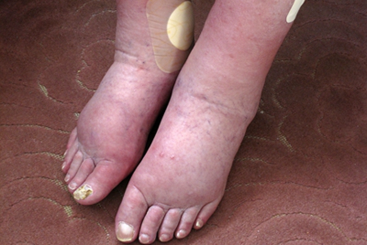 旋毛虫病脚部水肿图