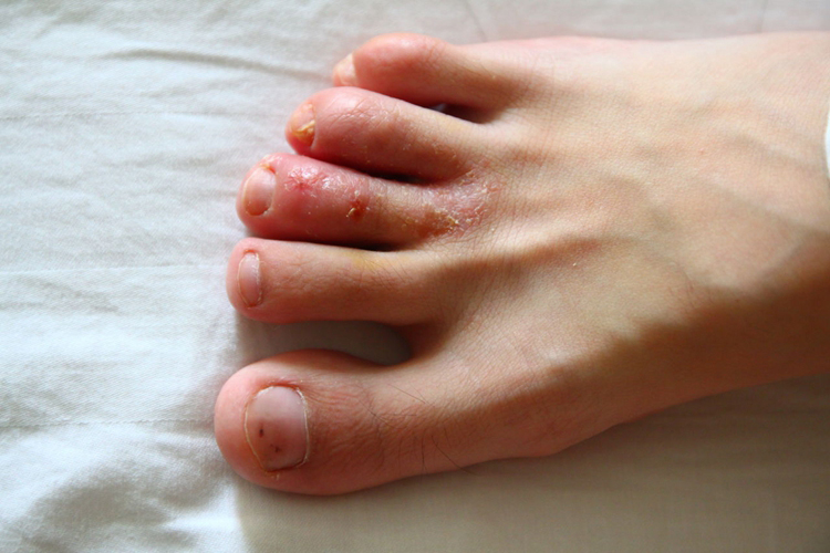 脚上长水锈图 脚上长水锈图