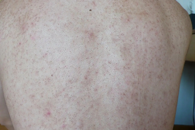 后背长鸡皮疙瘩图