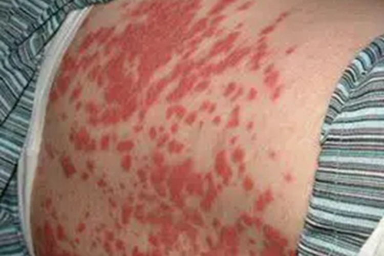 血栓性血小板减少性紫癜红斑图 血栓性血小板减少性紫癜红斑图