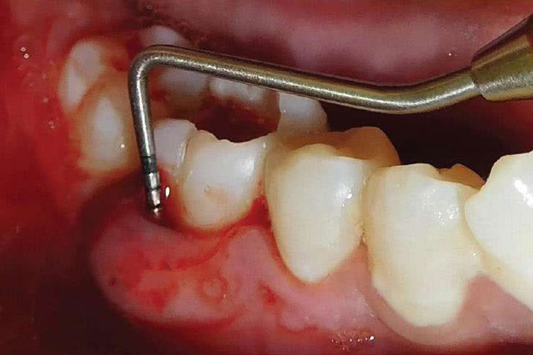慢性根尖周炎图 慢性根尖周炎图