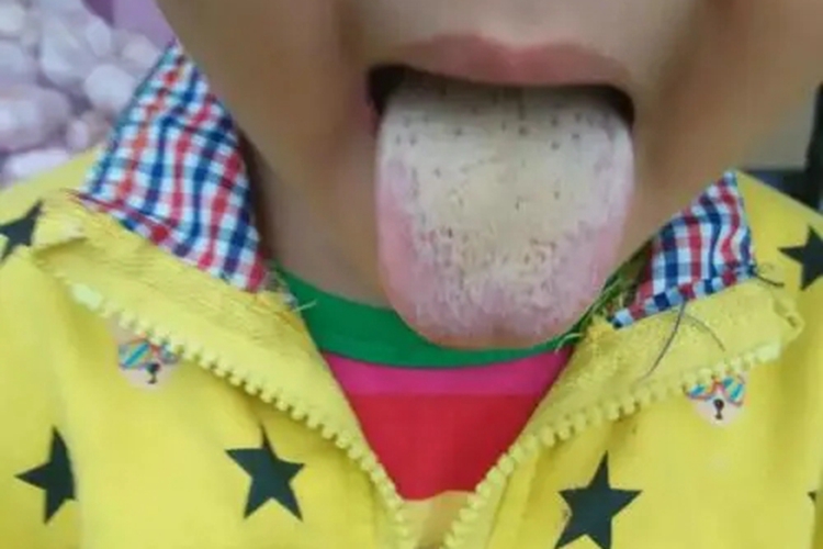 积食黄厚腻舌苔图