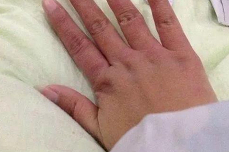 Ⅰ度冻伤手指症状图