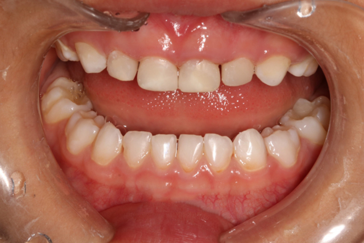 美牙冠试戴正式冠图