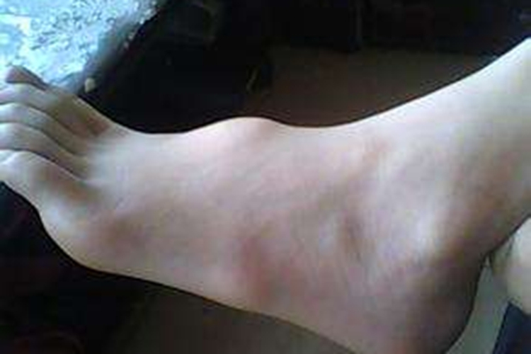 脚背腱鞘囊肿图 脚背腱鞘囊肿图