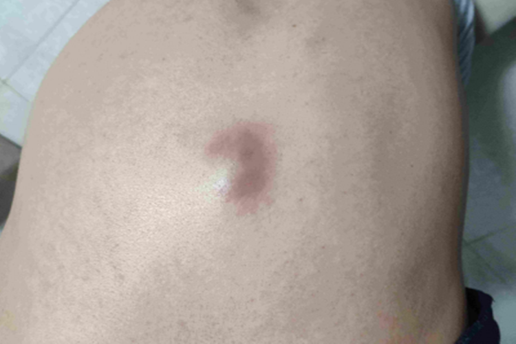 皮脂腺上皮瘤背部大包图