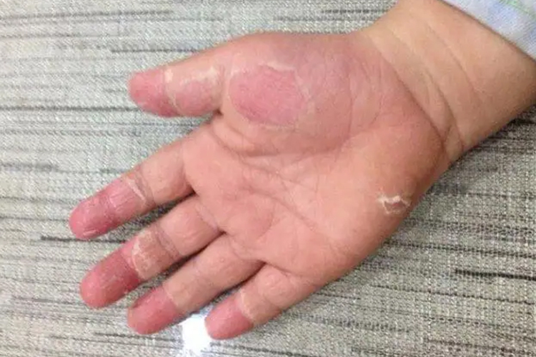 小儿鳞屑角化型手癣图