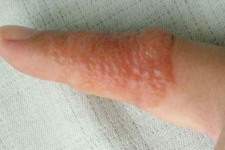 手指侧缘汗疱疹图