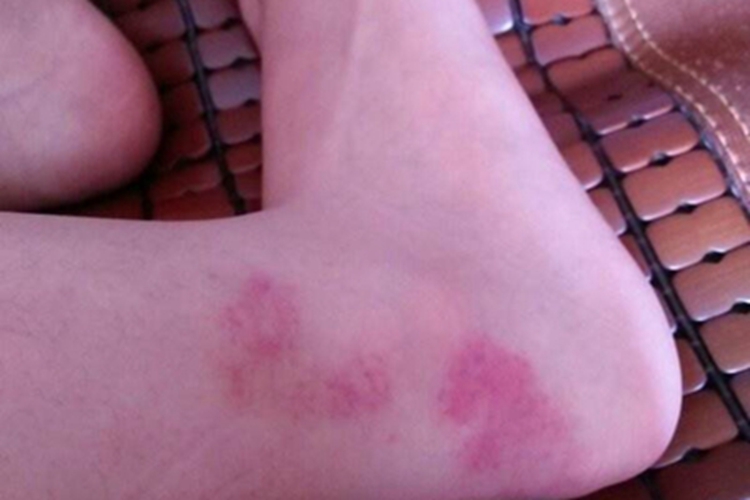 寒冷性多形红斑脚部红斑图