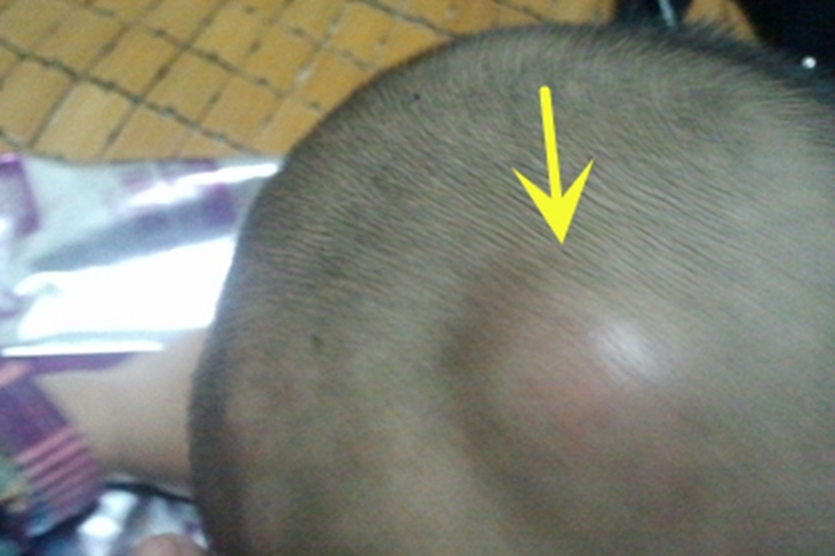 头皮血肿头部大包图