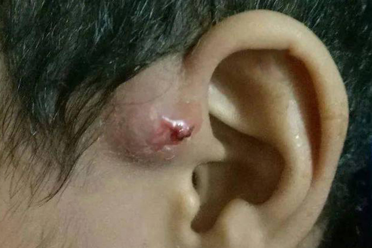 耳前瘘管发炎肿胀图
