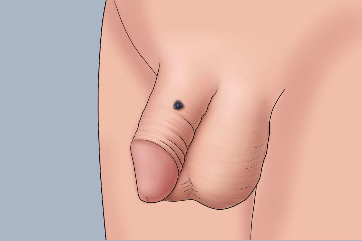 阴茎交界痣图 阴茎交界痣图