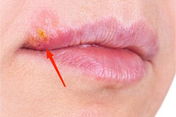 唇疱疹嘴角水疱破裂结黄痂图