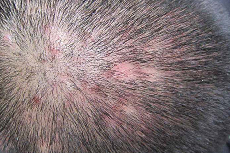 头生疮秃发性毛囊炎图