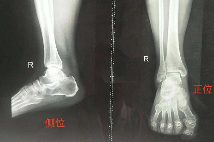 踝关节正侧位片图 踝关节正侧位片图