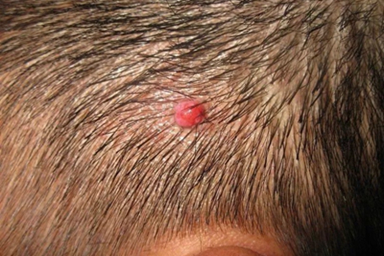 毛发肉芽肿头部疙瘩图 毛发肉芽肿头部疙瘩图