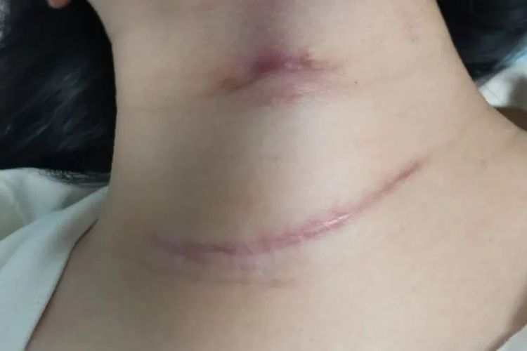 甲状腺术后增生性瘢痕图