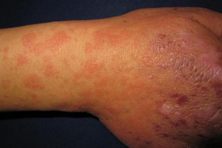 寒冷性多形红斑手背症状图