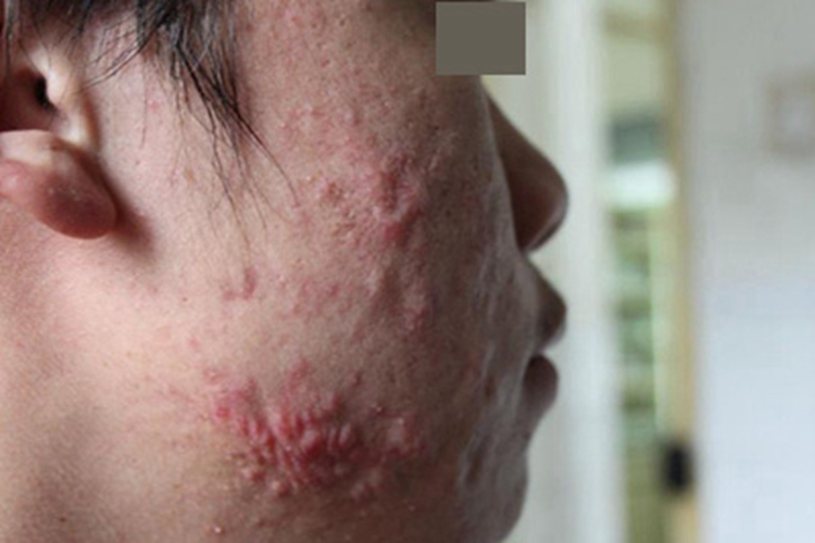 痤疮右脸红色疙瘩图