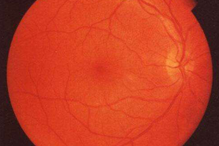 小孩视网膜震荡与挫伤图