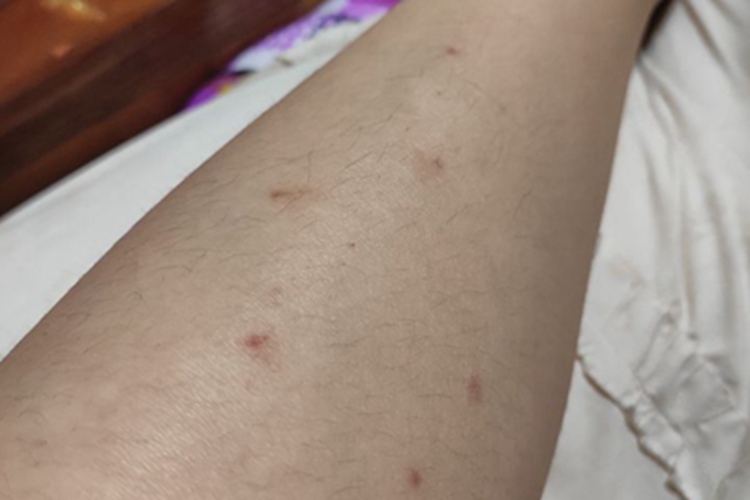 跳蚤叮咬小腿长小红疹图