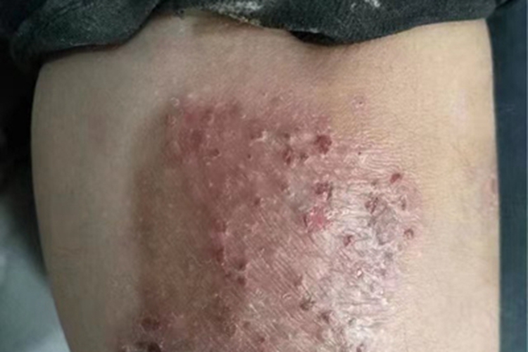 体癣小腿丘疹图