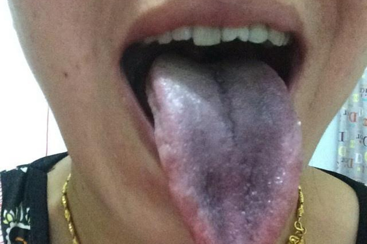 抽烟舌苔发黑图