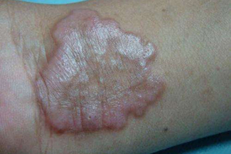 环状肉芽肿手腕症状图