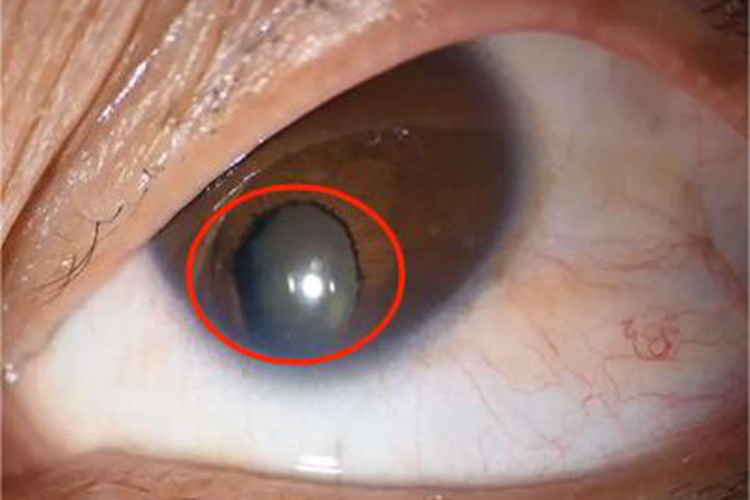 典型性虹膜缺损长斑图