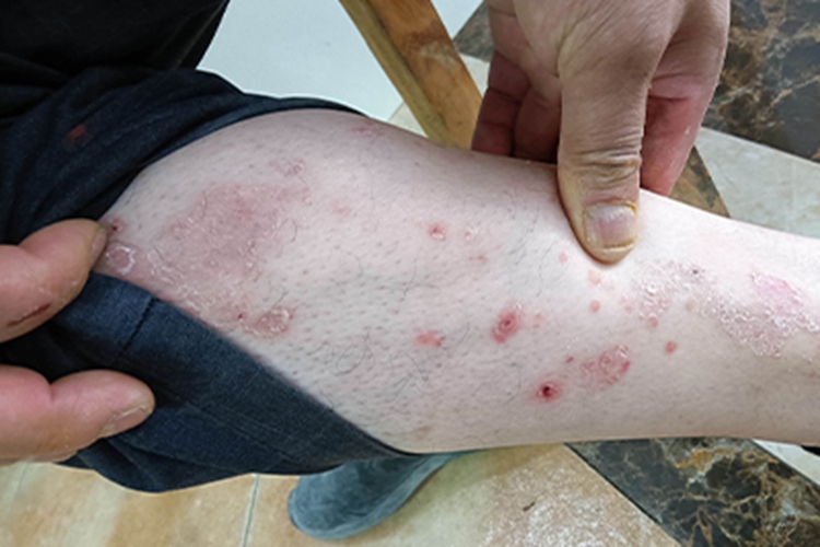 寻常型银屑病小腿症状图