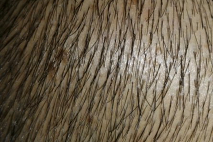 黑色毛结节菌病头发疙瘩图 黑色毛结节菌病头发疙瘩图