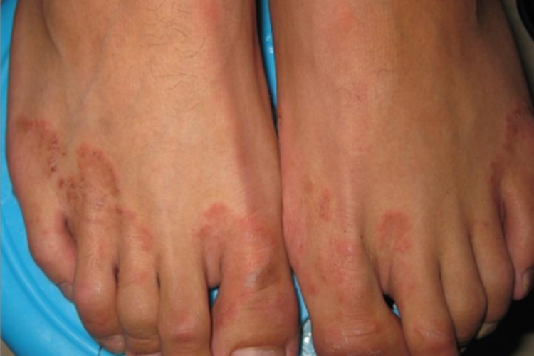 湿疹样型癣菌疹症状图