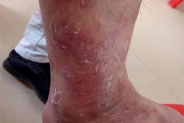 亚急性湿疹小腿发红结痂图